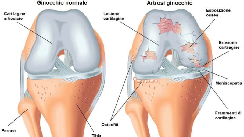 degenerazione cartilaginea disegno