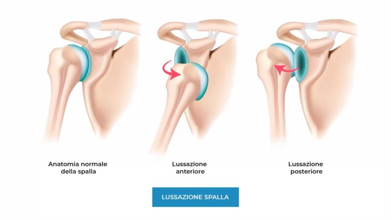 tipi di lussazione di spalla