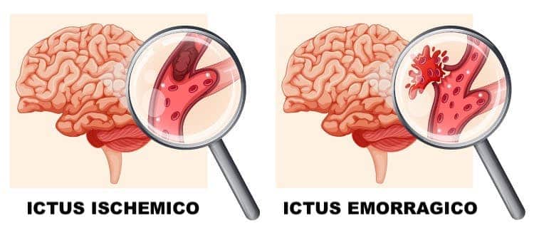 differenze tra ictus ischemico ed emorragico