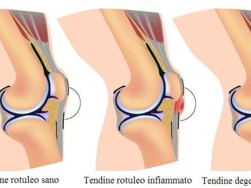 tendine infiammato e tendinite